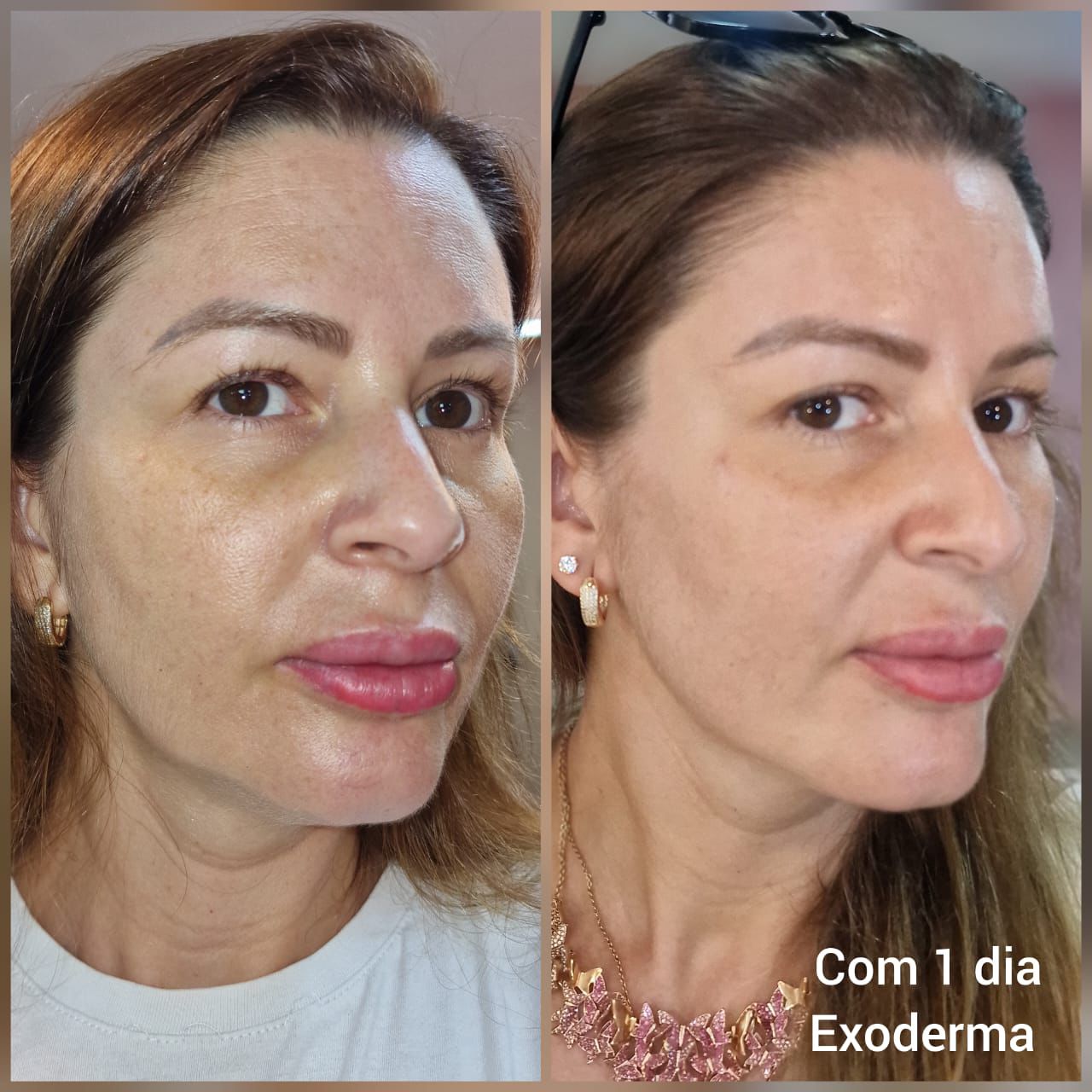 Exoderma — tratamento facial antes e depois