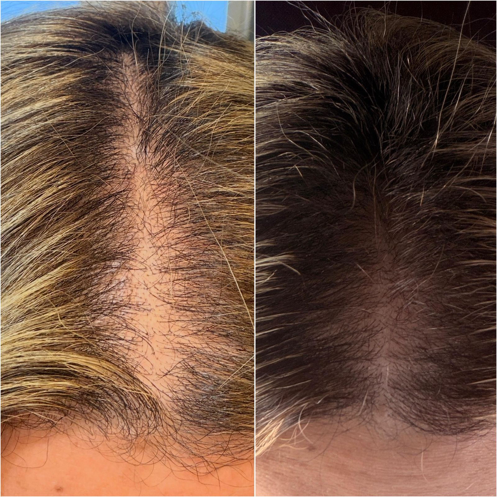 Exohair — regeneração capilar antes e depois
