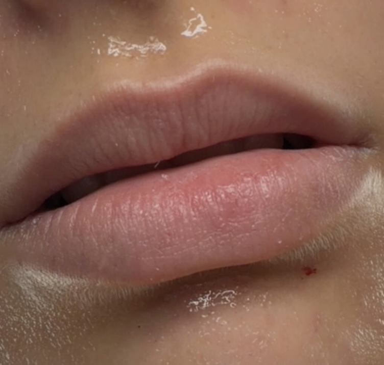 Hidragloss resultado 2 — antes